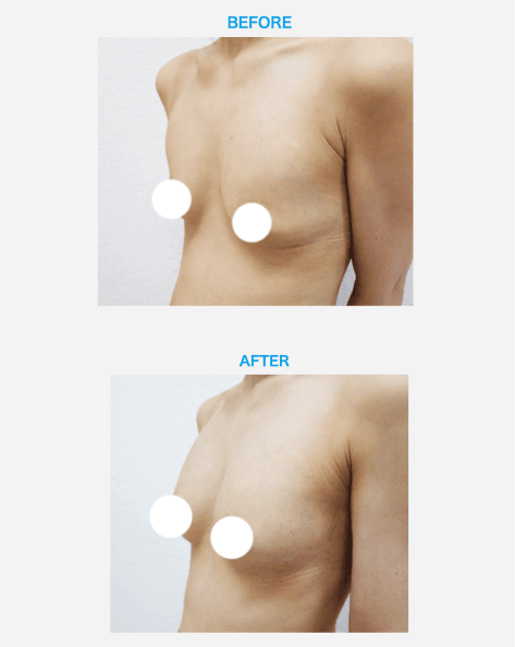 豊胸・バストケアイメージ