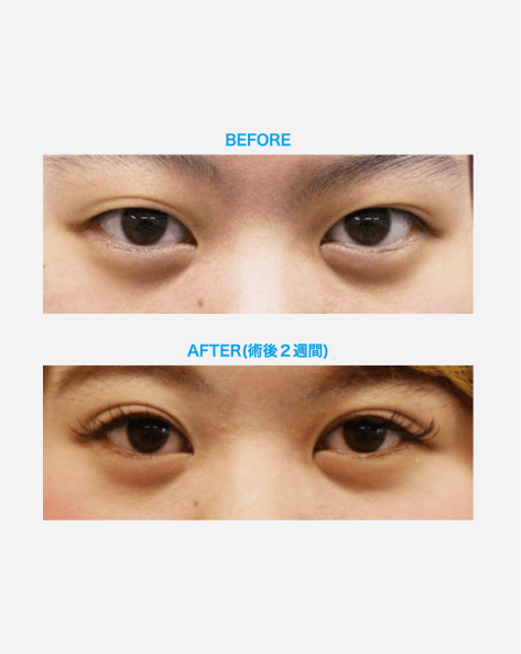 二重整形・まぶたイメージ
