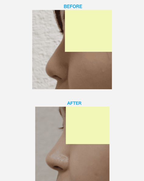 鼻整形イメージ